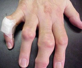 fingers with joint deformities cause pain