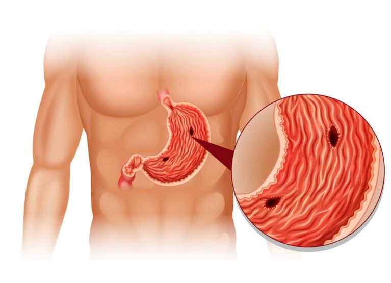 stomach ulcer as a cause of pain under the left scapula behind