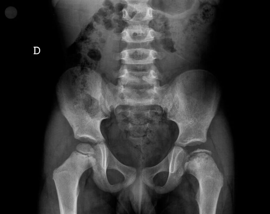 Legg-Calvé-Perthes disease – necrosis of the cartilage tissue in the femoral head