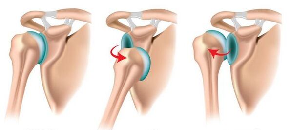 Anterior and posterior dislocation of the shoulder joint, provokes the development of arthrosis