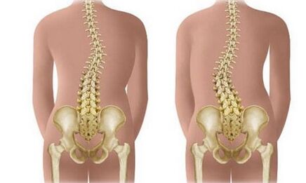 Non -Resisted Scoliosis