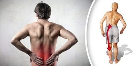 Pain syndrome with lumbar osteocondrosis radiates to the legs