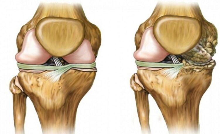 Healthy and influenced by arthosis joints