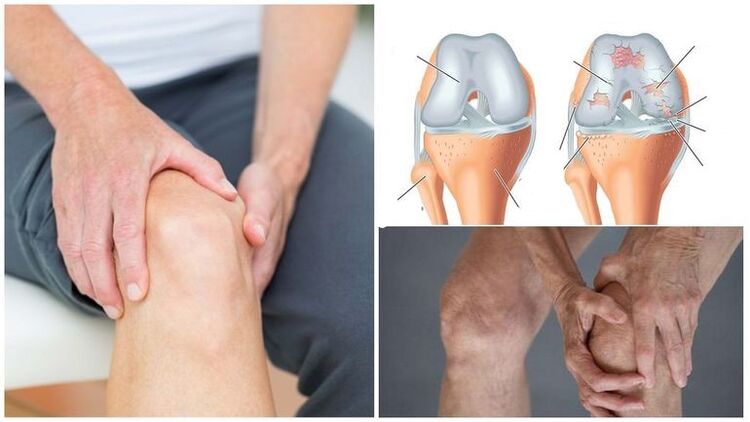 Knys pain symptom of arthosis in the knee joint