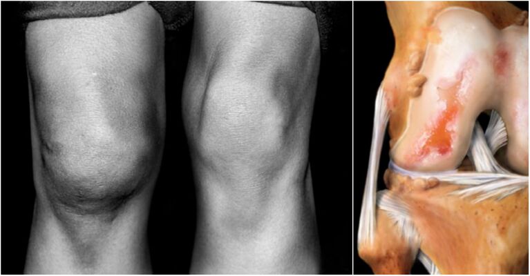 Osteoarthritis of the knee joint and sore joint