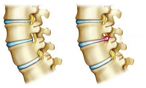 healthy disc and herniated disc
