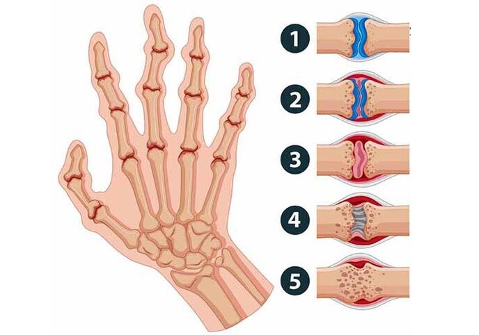 stages of development of arthritis in the finger joints