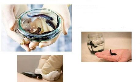 hirudotherapy for osteoarthritis