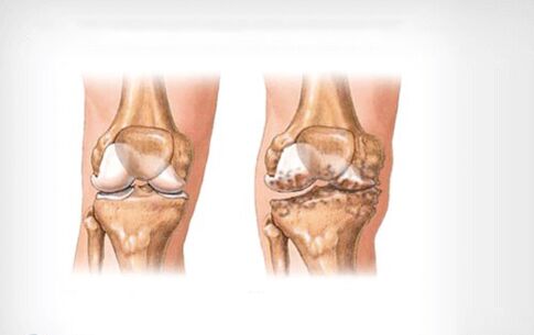 osteoarthritis of the knee joint