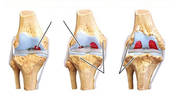 stages of knee osteoarthritis